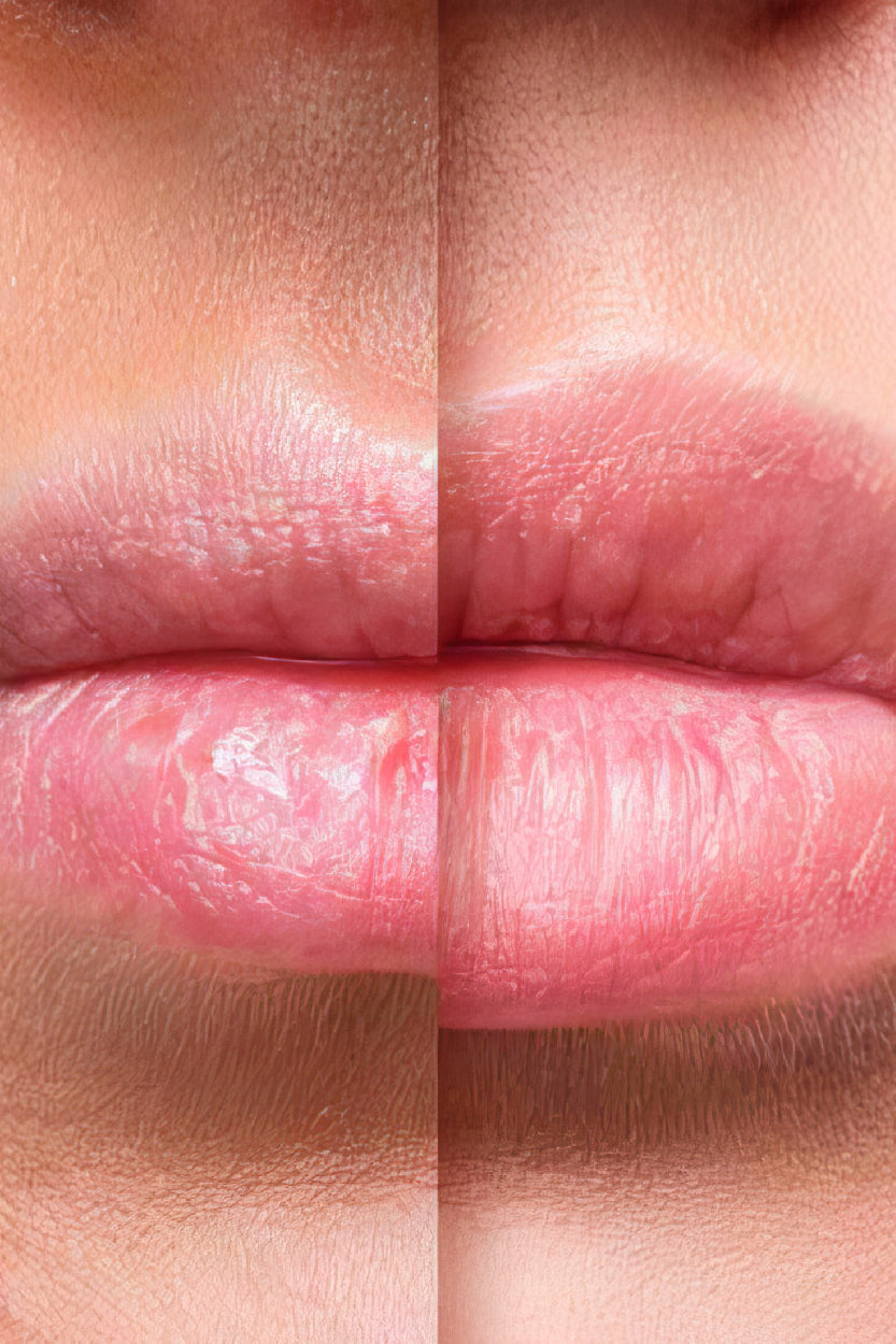Aumento de labios