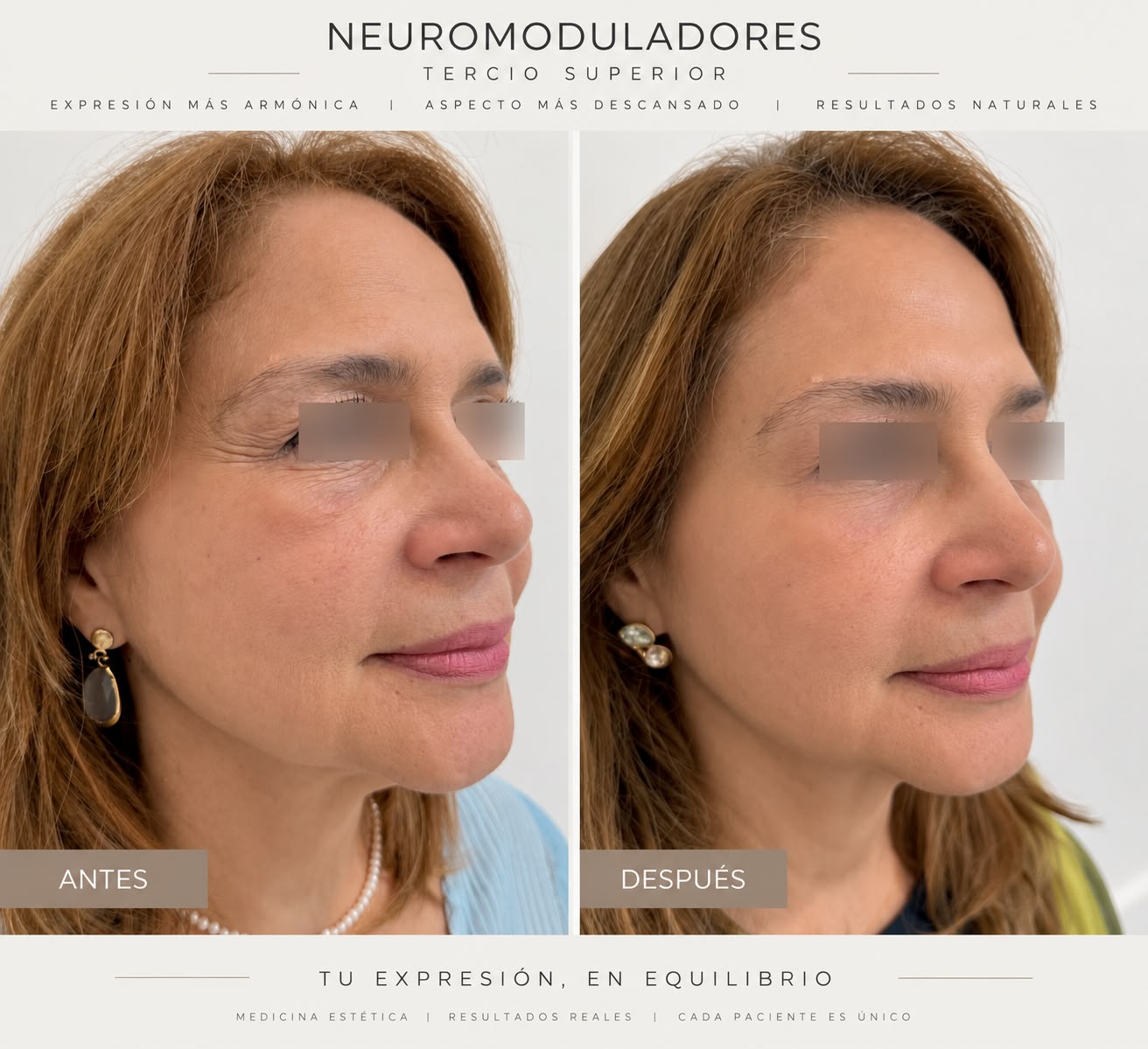 Neuromoduladores antes y después en MA BELLE Clinique