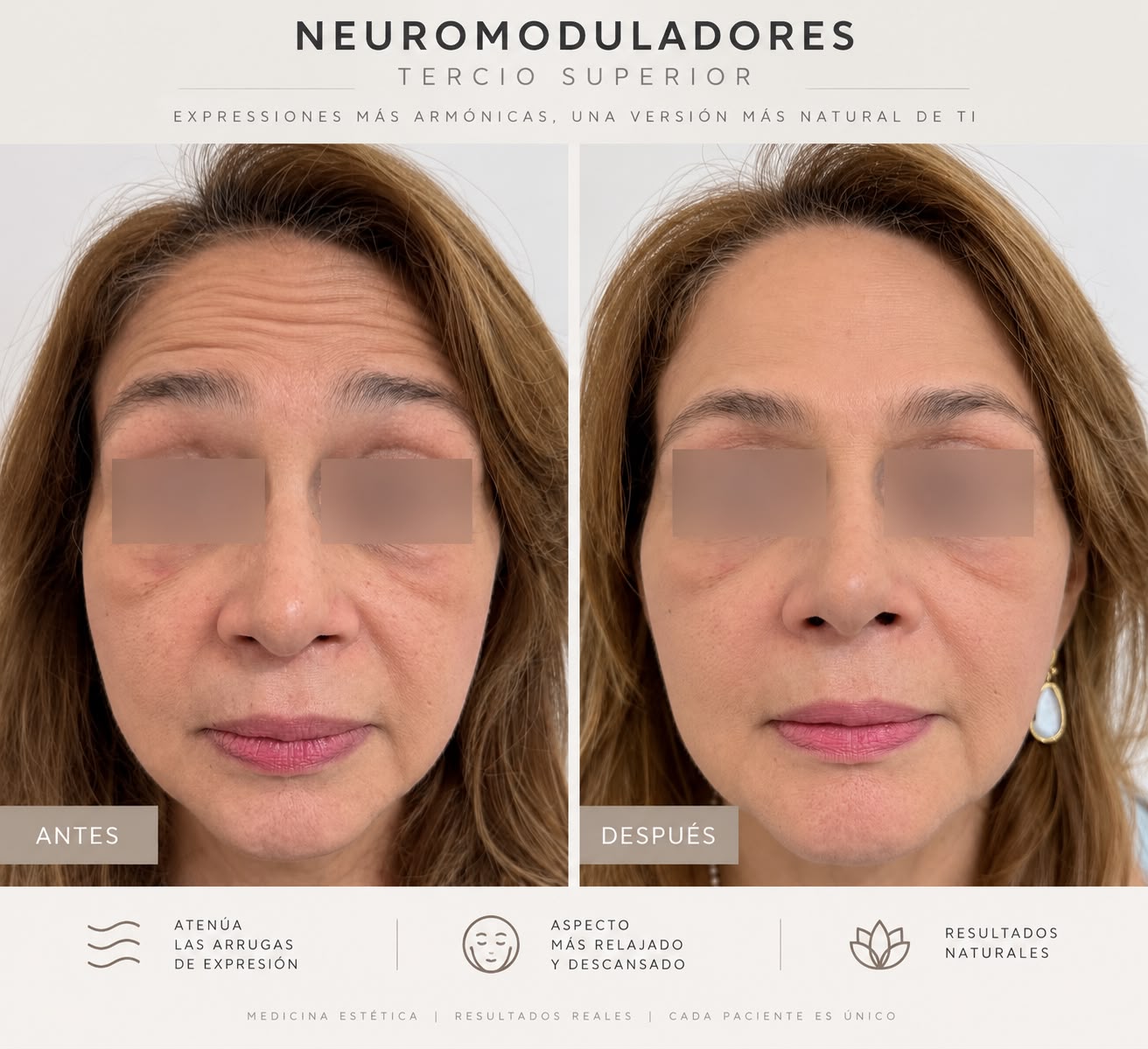 Tratamiento con neuromoduladores, resultado antes y después
